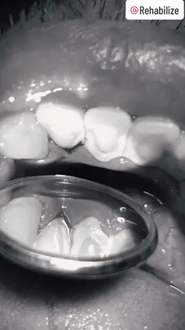 💎🦷💎Resultado de una limpieza dental profunda con ultrasonido en la cual eliminamos todo tipo de calculos dentales, placa bacteriana y sarro. 💎🦷💎 Recuerda que nuestras valoraciones son integrales. Puedes agendar la tuya por este medio o escribiendo a nuestro WhatsApp 📱953297939. #profilaxisdental #profilaxi #limpiezadental #limpiezadentalprofunda #limpiezadentalultrasonica #limpiezadentallima #blanqueamientodental #odontologia #aclaramientodental #sarro #sarrodental #calculodental #placabacteriana #ortodoncia #brackets #gingivitis #periodontitis 