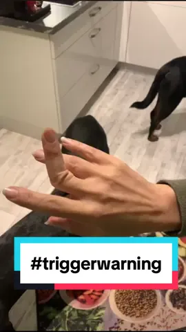 #needsomehelp #luxation #dislocated #finger #real #middlefinger #fingermagic #fingerthingy #accident  #no #pain #nofilter #no #prank #reallife #RealStory #doctor #calling #needed #help #triggerwarning #tw #horror #nichtsfürschwachenerven #horrormovie #contentwarning #trigger #fyp #marvel #foryou #astonishing #90 #grad #winkel #middlefingertrasition #funny #viral #onceuponatime #meme  #nopainnogain #lol #health #workout 