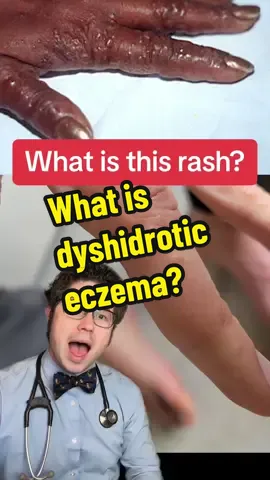 What is this rash? What is dyshidrotic eczema? How to treat dyshidrotic eczema? General educational purposes only. Not specific medical advice. #eczema #rash #tiktokdoc #LearnOnTikTok 