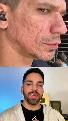 Amazing results @Ronny Rafaekson #phenolpeel 