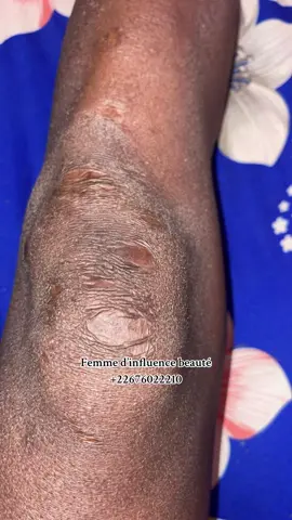 Le laser permet d'améliorer l'aspect des anciennes cicatrices, quel que soit le type de cicatrice - et ce sans impacter la peau saine à proximité. Il existe divers types de laser avec divers modes d'action (laser fractionnel, laser abrasif…). #laser #traitement #burkinatiktok🇧🇫 #viral 