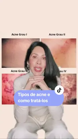 Ficou com alguma dúvida? Então me conta nos comentários! #acne #roacutan #tratamentodeacne #skincare #pelesaudavel #glowskin #cuidadoscomapele #peleoleosa #fyp #pravoce #dermato 