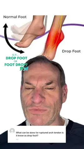 Is it Drop Foot or Foot Drop? 🦶 Today we discuss foot drop, the causes, and potential fixes for this problem.  Like always we suggest if this is a reoccurring and long term issue, you should address it with a specialist.  What do you call it drop foot or foot drop? #ankle #foot #injury #run #runners #Running #dropfoot #footdrop #podiatrist #podiatristsofinstagram #podiatristapproved 