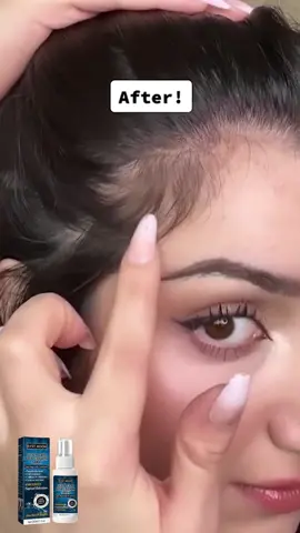 Use hair growth spray to grow hair easily #hairloss #hair #hairgrowth #hairoil #haircare 