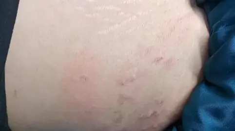 Chào mọi người mình là mít, chuyên mờ rạn da, mình xử lý tất cả các loại rạn mới cũ lâu năm. Mình hy vọng sẽ lấy lại sự tư tin về làn da cho chị em phụ nữ, nhất là các mẹ bầu sau sinh. Phương châm của mình là Hạnh Phúc là mang lại hạnh phúc cho nhiều người Mong mọi chị em phụ nữ luôn luôn yêu thương bản thân mình và sống một cuộc đời đáng sống #randa #rạn #dầu dừa #triranda #kemtriranda #kemranda #randa# #randamangthai #randadaythi #randatangcan #biooil #产后妊娠纹  #산후 튼살 #産後の妊娠線 #stretch mark pasca melahirkan #tanda regangan selepas bersalin #รอยแตกลายหลงคลอด #randasausinh #chuaranda #kemboiranda #cachchuaranda 