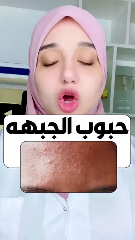 علاج حبوب الجبهة /الحبوب تحت الجلد/حب الشباب