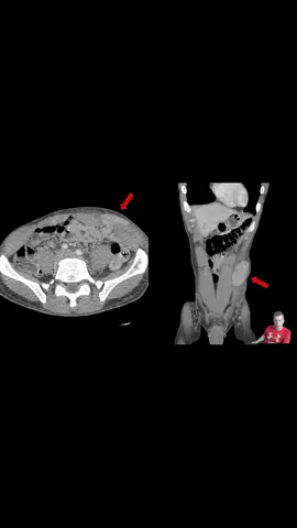 We present a really interesting case of a patient who took a bicycle handlebar to his abdomen and presented with a “protrusion” https://mededcases.com/spigelian-hernia/ #MedEd #MedicalEducation #Medicine #MedSchool #MedStudent #physicianassistant #nurse #doctor #nursepractitioner #paschool #medicalschool #palife #physicianassistantlife #nursing #EmergencyMed #Trauma #GenSurg