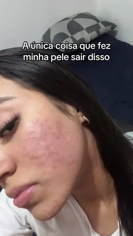 Obs: requer acompanhamento médico é apenas minha evolução #FalaGalvao #viral #acne #removerespinhas #foryou 