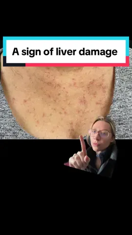 A few small spider angiomas can be normal and seen in healthy people. Sometimes they can develop in pregnancy or while taking oral birth control. Patients with advanced liver disease/cirrhosis typically have numerous and larger ones.  #medicine #LearnOnTikTok #dermatology #alcohol #liver #health #greenscreen 