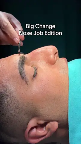 Thick skin male rhinoplasty, result speaks for itself #rhinoplastyturkey #nosejobturkey #nosejobbeforeandafter #nosejobcheck #rhinoplasty #nosejob #rhinoplastybeforeandafter 