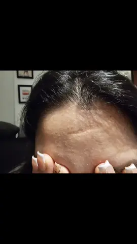 Eliminar cicatrices y estrias es posible con nuestro tratamiento  de PLASMAPEN podemos ver como la cicatriz reduce de tamaño y profundidad #plasmapen #cicatriz #estrias #reducircicatrices 