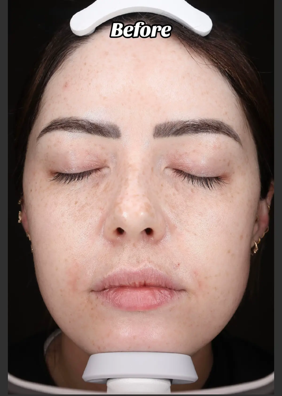 Targets - pigment/ brown spots / redness / pores / texture . One of the best treatments ive done  (Gifted ad treatment but not asked to post review not paid just obsessed)