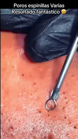 #Extracción #poros #granos#pelo #espinillas #limpiezafacial #acne #tratamientos 