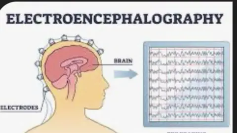 Electroencephalography, Noun, the measurement of electrical activity in different parts of the brain and the recording of such activity as a visual trace. Also known as EEG, DETECTS ACTIVITY OF LARGE GROUPS OF NEURONS THAT ARE ACTIVE AT THE SAME TIME #word #words #wordoftheday #elctroencephalography 