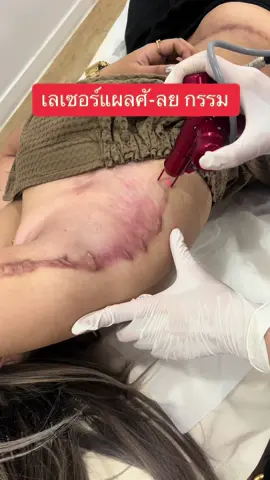 แผลศั-ล ย กรรม ตั-ด ท้องแขน เลเซอร์ร่วมกับฉี-ด คีลอยด์ #แผลเป็น #เลเซอร์แผลเป็น #แผลผ่าตัด #คีลอยด์  @Lovelymedclinic  @Lovelymedclinic  @Lovelymedclinic 