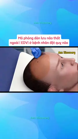 Mô phỏng dẫn lưu não thất ngoài (EDV)#kienthuc #ykhoa #phauthuat #yte #dotquynao 