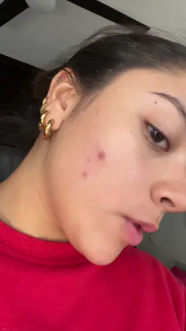 ¿Por que se manchan tanto? #acne #granitos #derma 