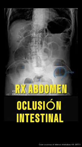 Con una “Simple” placa de abdomen.  #cirugia #radiologia #gastroenterologia #medicina #rayosx #enarm #estudiantedemedicina #signoclasico #triada #residente #enarm2024 #oclusionintestinal #diagnostico #tratamiento 