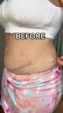 Abera Scar Cream - Treatment for Face and Body, Rapidly Removes Stretch Marks, Keloids, Burns
