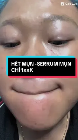 Đặc trị tất cả các loại mụn⁉️ Bạn đang sd trị mụn,bạn đang gặp tình trạng mụn nặng ,..v..v.. Đã sd nhiều sp nhưng ko hiệu quả thì hãy đến vs #Skinbeauty bên em sd sau 7-10 ngày ko hiệu quả hoàn tiền 100% cho các ace ạ #hetmun #skincare #xuhuongtiktok #xh 