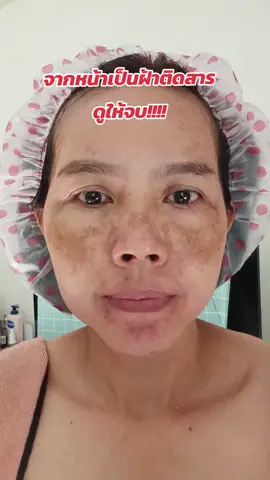 หลายคนสงสัยฝ้าหายเกลี้ยง ยารักษาฝ้ามันเริ่ดมาก #หน้าตาที่เปลี่ยนไป  #เปิดค่าการมองเห็น  #ครีมกระแสเป็นเหตุ  #ผิวหน้าดีไม่ง้อครีม 