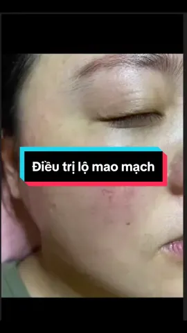 Da lộ mao mạch, mỏng yếu  #dieutrigianmaomach #damongyeu #mesotherapy 