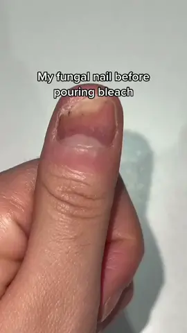 Look at my nail fungus healing routine #nailfungus #nailfungustreatment #nailfungus? #onychomyvosis #nailscare #clearzal #antibacterial #TikTokShop 