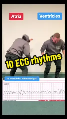 10 ECG rhythms through the medium of dance 1. Normal Sinus rhythm (NSR) 2. Atrial fibrillation  3. Ventricular standstill 4. NSR with PVC 5. Second degree AV block mobitz I 6. Second degree AV block mobitz II 7. Third Degree heart block (complete) 8. Ventricular tachycardia (VT) 9. Asystole 10. Ventricular fibrillation  . . 👊 Hit follow & like for more prehospital content . . 🖥️ head over to www.themedicallounge.co.uk and sign up for incoming educational courses and quizzes. . . 🛒 Head over to our Etsy shop www.themedicallounge.etsy.com for prehospital products . . Or visit our TikTok shop . . 📸 Jason Winter 2017: ECG educator and medical illustrator  . . Links also in bio . . #ecg #ekg #cardiology #medicaltiktok #healthcare #medtok #medicalstudent #studentnurse #paramedic 