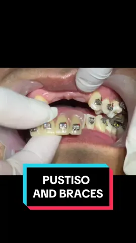 Pustiso at braces? 🦷🫡 #denteetha 