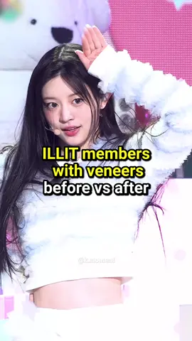 Ib: @aa ILLIT member with veneers before vs after #kpopfyp #kpopers #kpop #fyp 