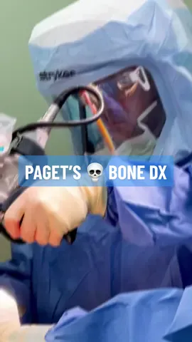 Common Bone Disease 🔴 Classic Paget disease of bone occurs in approximately 1 percent of people older than 40 in the United States. Scientists estimate that about 1 million people in this country have the disease. It is most common in people of western European heritage. Early-onset Paget disease of bone is much rarer.S Paget's disease of bone interferes with your body's normal recycling process as new bone tissue gradually replaces older bone tissue. Bones can become fragile/deformed, accelerating joint arthritis damage How Common is #PagetDisease  Risk of Paget's #bonedisease increases with age and occurs in ~1% of adults >40. In most cases, Paget's disease is asymptomatic and progresses slowly. Possible complications include:   - Fractures/ bone deformities (leg bowing): bones break more easily, and extra blood vessels in these deformed bones cause them to bleed more during repair surgeries.    - Osteoarthritis: Misshapen bones increase stress on joints leading to #osteoarthritis damage   - Neurological problems: Bone overgrowth can compress/damage nerves causing pain/weakness/tingling (arm, leg, hearing loss)   - Heart failure   - Bone cancer (up to 1%) Diagnosis/Imaging: first indication of #Pagetsdisease of bone is often abnormalities found on X-rays (done for other reasons). X-ray can show areas of bone breakdown, enlargement of bone/deformities and/or long bone bowing Bone scan.  Treatment If disease is active — elevated alkaline phosphatase level — and is affecting high-risk sites treatment may be indicated   - Medications: #Osteoporosis drugs (bisphosphonates). If bisphosphonates aren't tolerated, calcitonin (Miacalcin), may be prescribed   - Surgery: In rare cases, surgery might be required to:   - repair fractures   - Replace joints damaged by severe #arthritis (Total #KneeReplacement shown)   - Realign deformed bones   - Reduce pressure on nerves . If scheduled for surgery that involves bones affected by Paget's disease, you may be prescribe medications to reduce the active disease, helping to reduce blood loss during surgery 🎶 @Chandler 🎥 Mako Robotic-assisted Total Knee Replacement