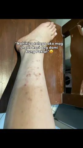 Super highly recommend kotong nakita kung scar remover cream super effective at sulit pa sa budget!!💖🫶🏻 #verdefy #verdefyph #scarremovercream #scarlighteningcreambyverdefy #fyp #trending 