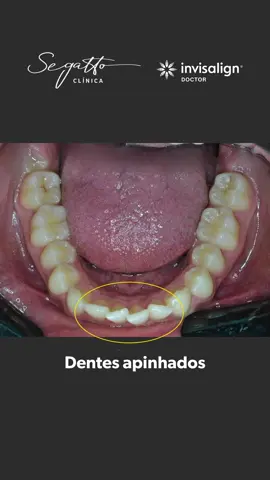 Paciente sofria de apinhamento severo nos dentes inferiores e sua principal queixa era a questão estética. Após o tratamento, solucionamos a queixa do paciente e alcançamons uma boa melhora na mordida. Paciente tratado com Invisalign®️. Agende sua avaliação pelo WhatsApp e saiba mais sobre Invisalign®️ na Segatto Clínica. Dr. Marcelo Segatto | Invisalign®️Doctor Diamond • WhatsApp: (16) 99974-0065 • São Jm. Barra/SP | Rua Rio de Janeiro, nº 221 - Centro • Orlândia | Av. Onze, nº12 - Centro #ortodontiasaojoaquimdabarra #ortodontiaorlandia #invisalign #invisalignorlandia #drmarcelosegatto #orthofisio #orthofisioclinica #invisalignorthofisio #invisalignsegatto #ortodontiadigital #itero 