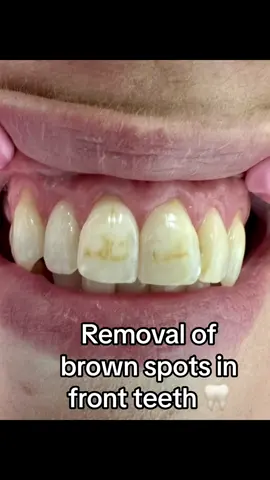 Icon Resin Infiltration treatment to remove Brown and white spots from teeth #iconresininfiltration #dentalspa #fyp 