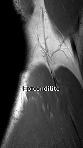 Il gomito del tennista ha spiegato: cause, sintomi e soluzioni  #Fitness #videoviral #sport #wellness 