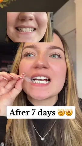 7 days of using teeth whitening strips and 🤯🤯🤯 incredible teeth whitening results!!!! ✨👏 #teethwhiteningresultsuk #teethwhiteningstripresults #teethwhiteningtransformation 