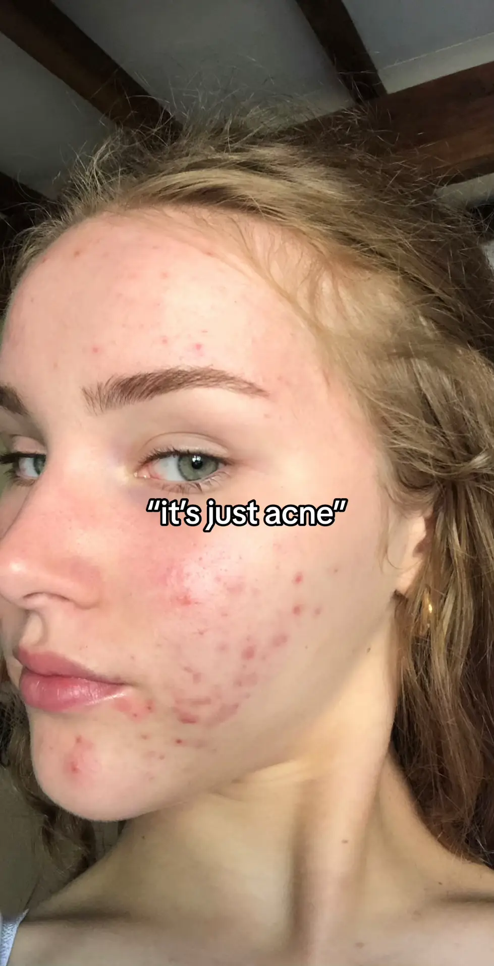 do you agree?💗 *acne healing guides are in my bio* #acne #acneproneskin #clearskin #skincare #skintok #MentalHealth #fyp #explore #acnementalhealth 