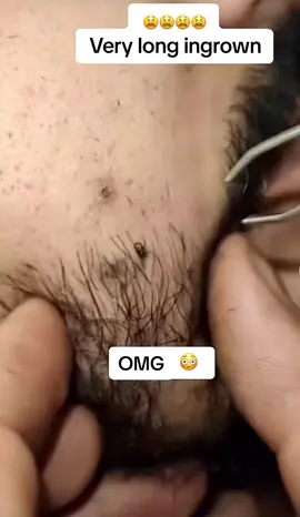 #beardhair #mens #ingrownhair #hairproblems #vietnam #hongkong #beijing #f #viral 