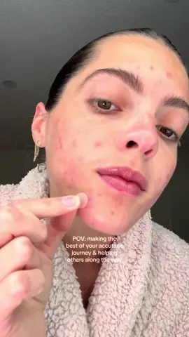 there is no community like the #acnecommunity 🥲💗🧚🏼🫧 #acnefighter #acne #adultacne #hormonalacne #cysticacne #skinhealth #skin #skincare #accutane #accutanejourney 