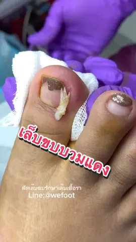 เล็บขบบวมแดง มีหนองตัดเล็บขบด้วยตัวเองแล้วไม่ออกคะ#wefootตัดเล็บขบรักษาเล็บเชื้อรา #ตัดเล็บขบ #ingrowntoenail #เล็บขบอักเสบ #ตัดเล็บขบมียาชา #เล็บขบหนักมาก #เล็บขบ 