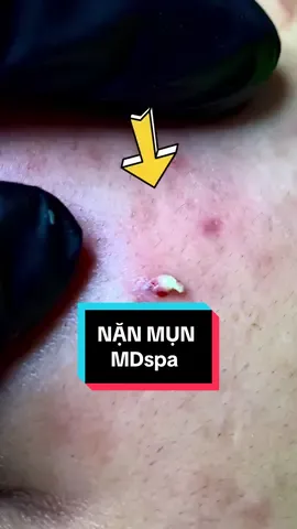 #nặn_mụn #lêthithuydung616 #chuyên_đtri_mụn_rỗ_tpvinh_nghệan #mdspa_chuyên_mụn_rỗ_tpvinh #
