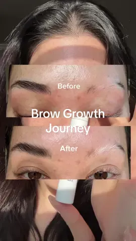 Four weeks of using @olaplex new BROWBOND Building Serum. I can’t wait to see what they look like at 8 weeks 🙌🏼  #BrowBond, #OLAPLEX, #OlaplexPartner #vitiligo #poliosis #eyebrows 
