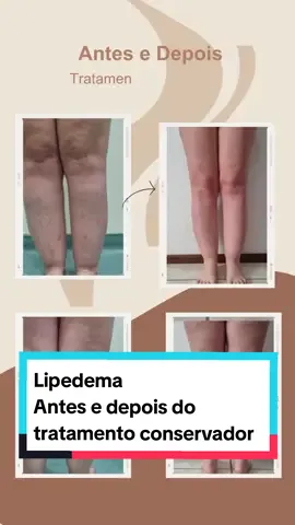 Antes e depois do Tratamento conservador Resultados que fazem a diferença na sua qualidade de vida. Cuide da saúde, que estética vem de brinde. #lipedema #restauranterj #lipedemalegs #lipedemalegsp #lipedemalegsp #lipedemabrasil #lipedemagirl #lipedemasc 