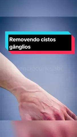 Removendo cistos gânglios #vocesabia #ciencias #curiosidades #corpohumanocuriosidades #curiosidade 