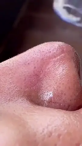 vacuum blackhead removal #vacuumcleaner #facialtreatment #acnetreatment #photorejuvenation 