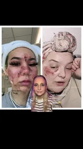 #skincare #patchtest #skin #burns #chemicalburn #reaction #facemask #teen #tween #beauty #BeautyTok #beautytips #plasticsugery #chemicalreaction 