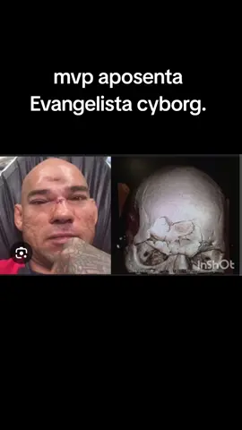 Michael page acertou uma joelhada de encontro na testa do Cyborg que precisou passar por cirurgia complicada para reconstruir o crânio #UFC #fyp #mma #mvp #conormcgregor #pravc #danawhite #viral #segue #box #kickboxing #karate 