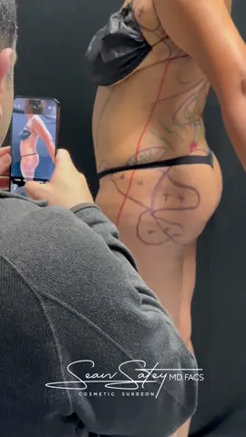 Ever wondered how to achieve NATURAL contours without looking overdone? Meet our patient who chose VASER liposuction and J Plasma for body sculpting. But here's the twist: she insisted on MINIMAL fat transfer to maintain a natural appearance. Ready to sculpt your dream silhouette with Dr. Satey's expertise? 💫 #JPlasma #VASER #Liposuction #DrSeanSatey