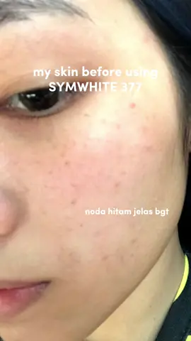 Kuncinya, sabar dan rutin😌 #skincare 