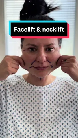 1 day after deep plane facelift & deep necklift😊 All done in local anesthesia💉💪🏻 📲 If you want to make an appointment, contact us at info@v-clinic.cz #facelift #necklift #plasticsurgery #plasticsurgeon #plastickachirurgie #ventruba #vclinic #transformation #beforeandafter 